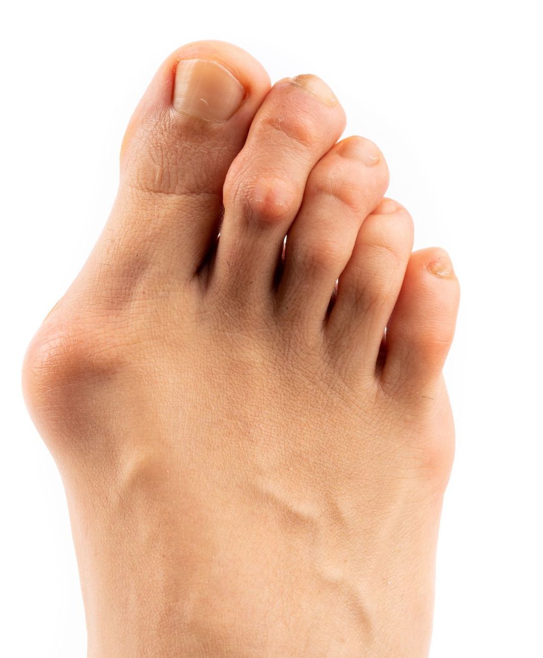 bunion