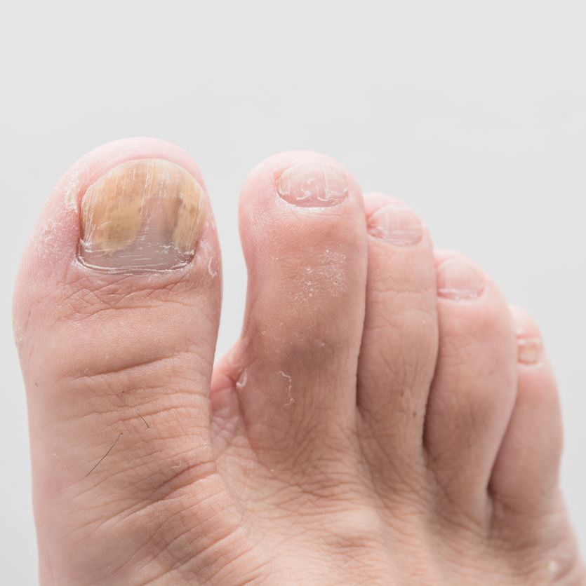 toenail psoriasis