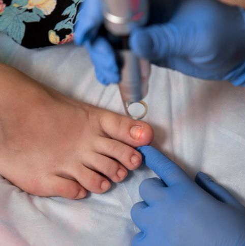 Toenail fungus treatment with foot laser at laser nail therapy clinic. - Image