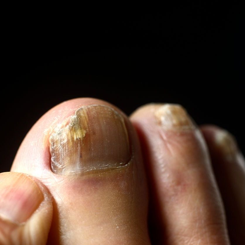 toenail fungus