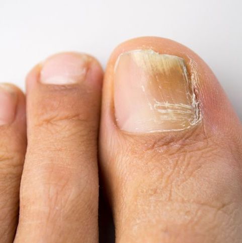 onychomycosis with fungal nail infection