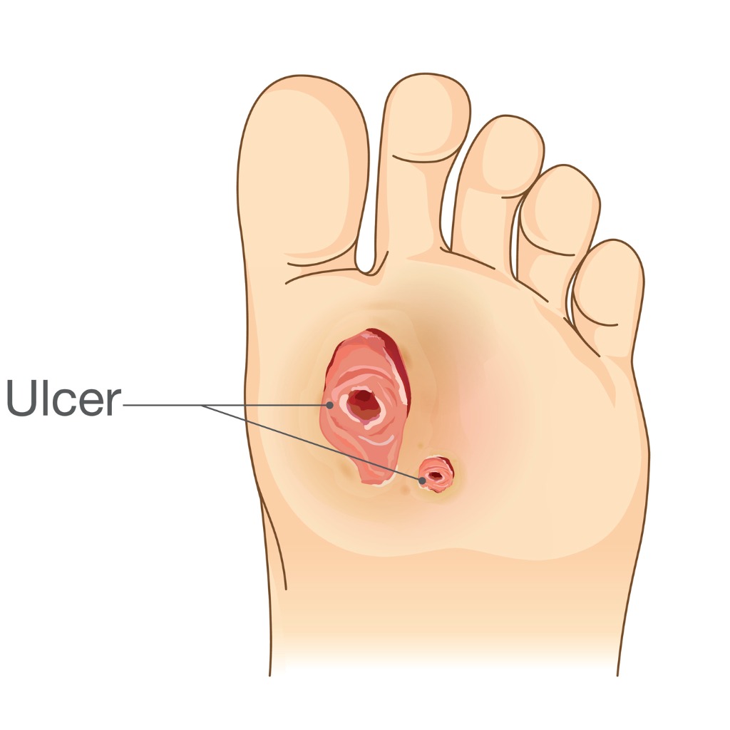 illustration of a diabetic foot ulcer